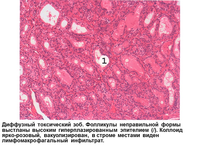 Диффузный токсический зоб. Фолликулы неправильной формы выстланы высоким гиперплазированным эпителием (/). Коллоид ярко-розовый, вакуолизирован,